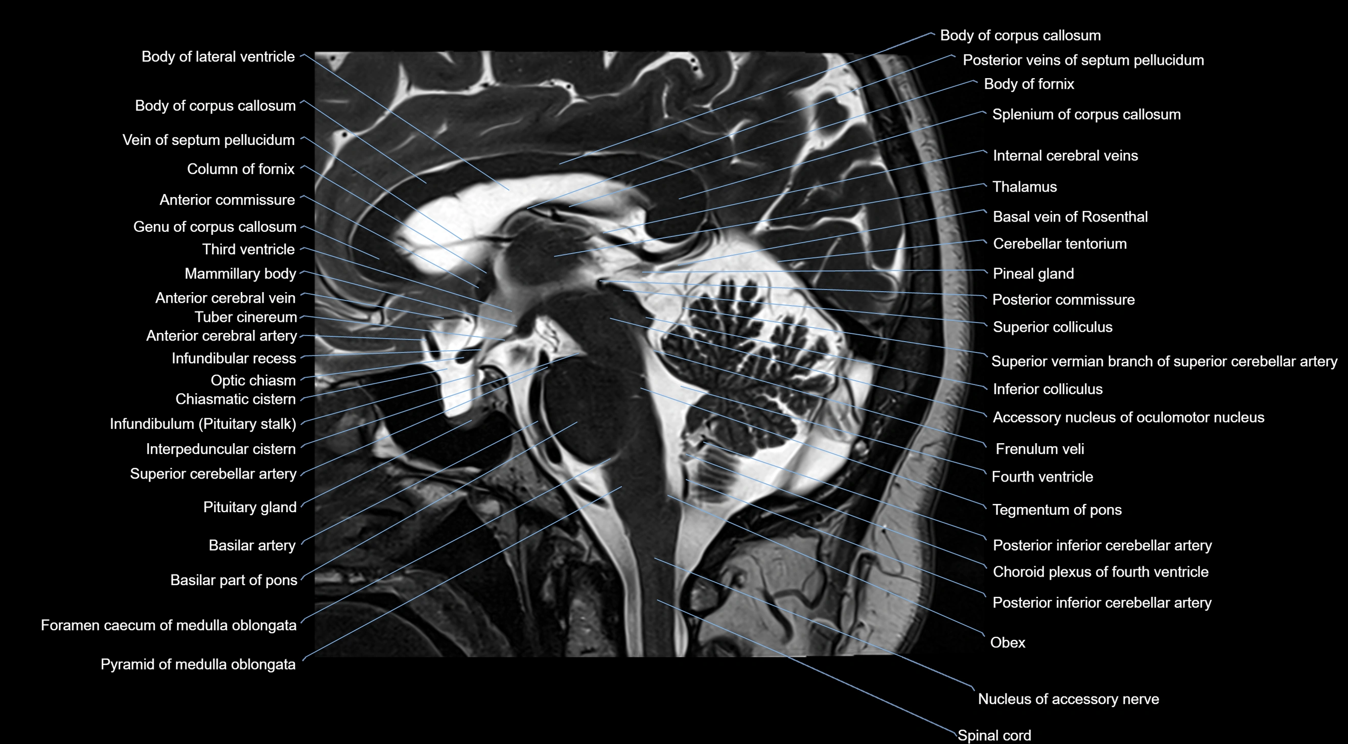 MRI brainstem & basal ganglia anatomy labelled  3T MRI images -img-10001-00023.webp